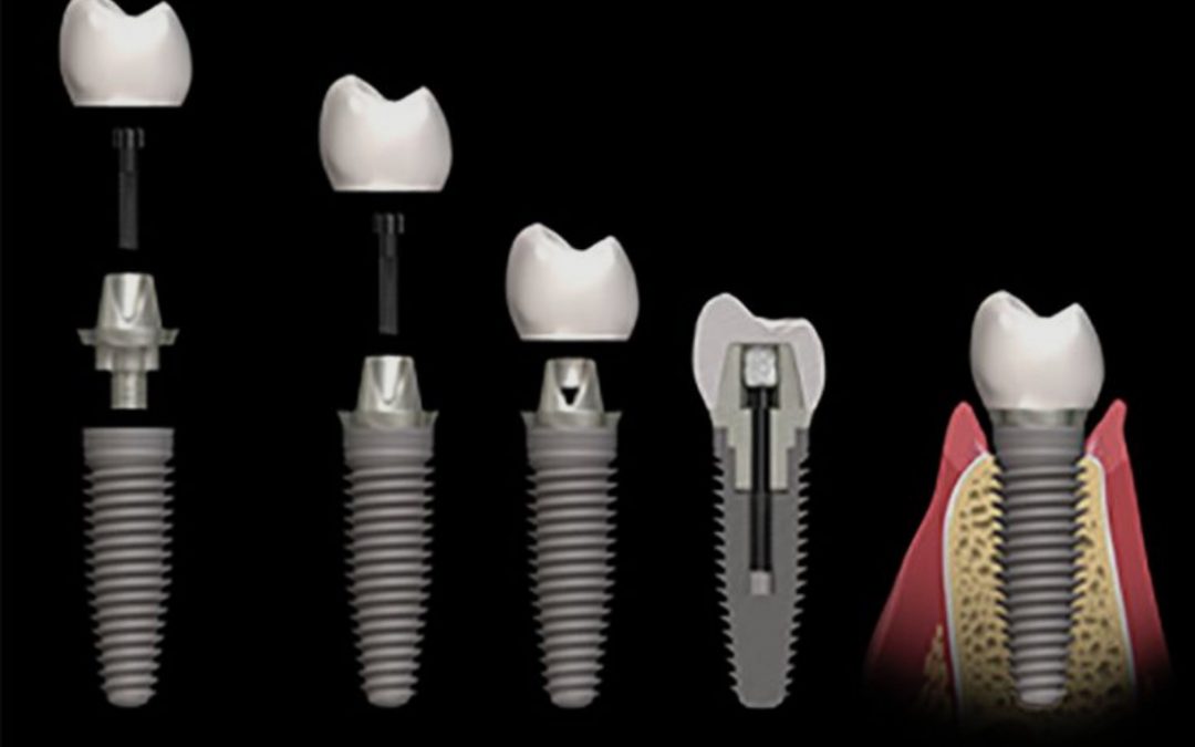 Implantes Dentales sin dolor