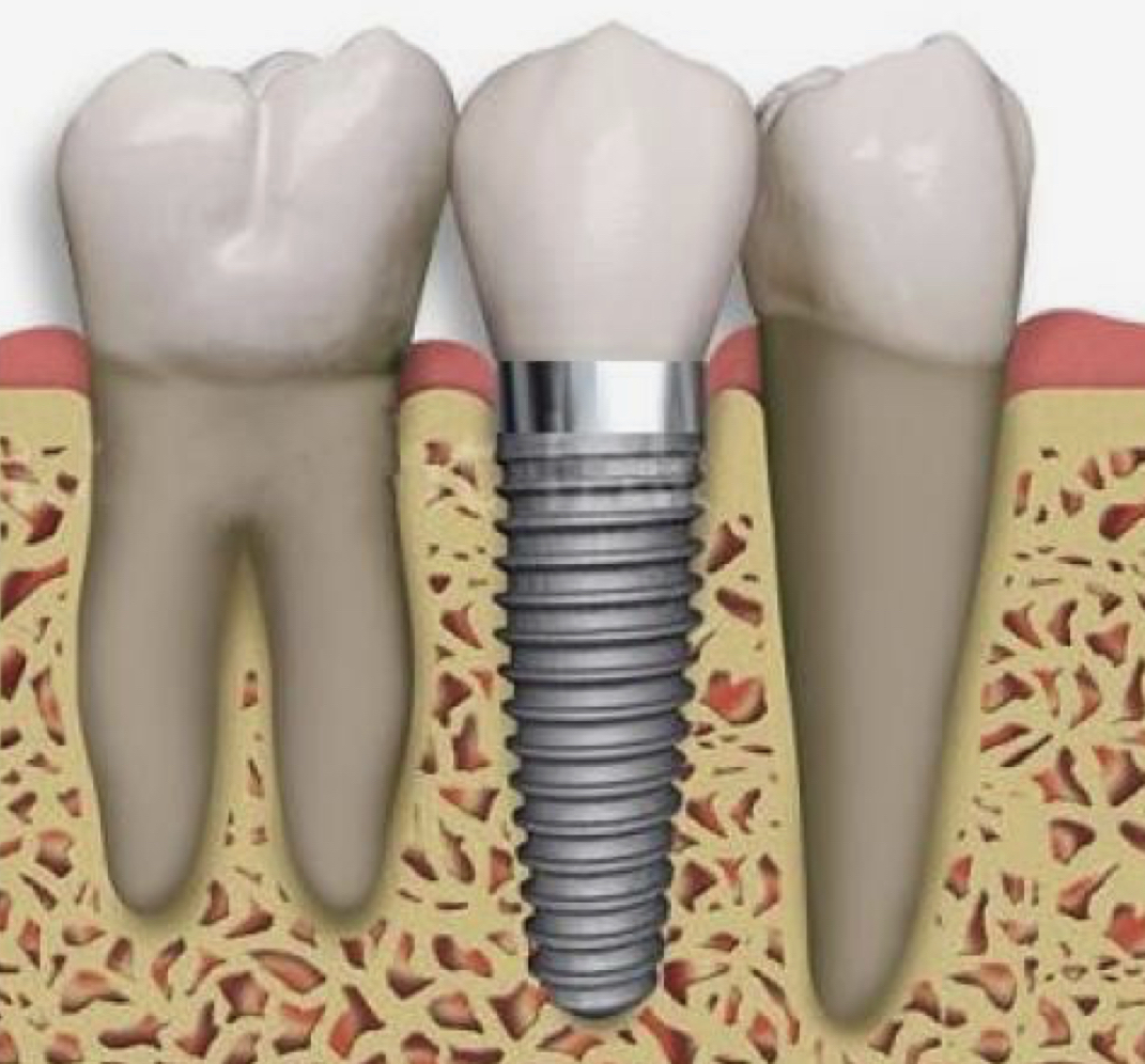 Mantenimiento de los Implantes dentales en Madrid centro - GONZÁLEZ Y